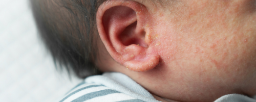 Image of a babies ear with a skin condition sourced from Canva.com